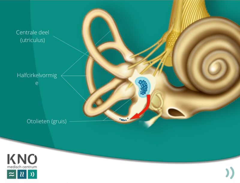 BPPD Duizeligheid Bij Bewegen KNO MEDISCH CENTRUM