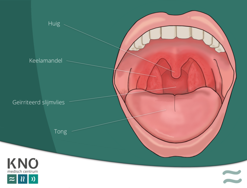 Keelontsteking (faryngitis) KNO MEDISCH CENTRUM