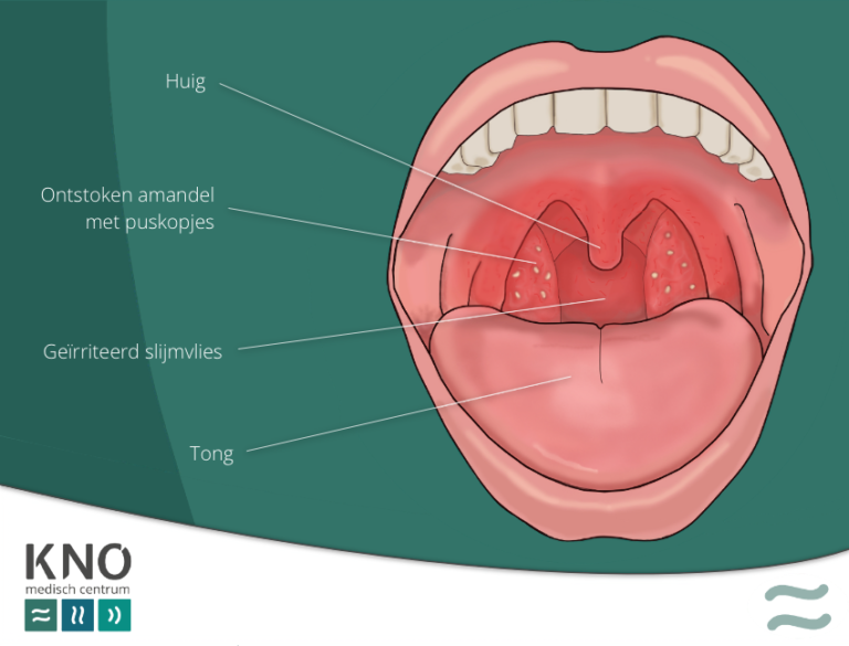 ontstoken amandelen (tonsillitis) KNO MEDISCH CENTRUM