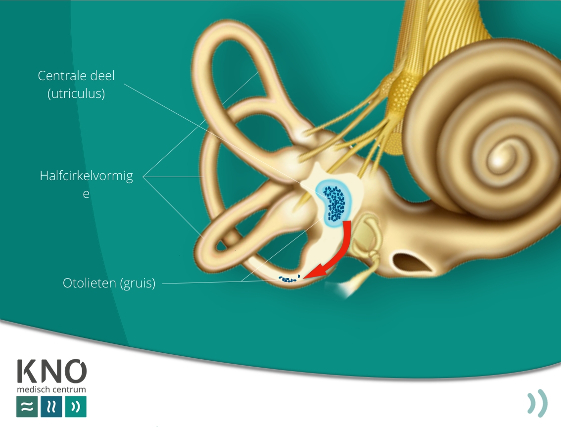 BPPD (duizeligheid bij bewegen) - KNO MEDISCH CENTRUM