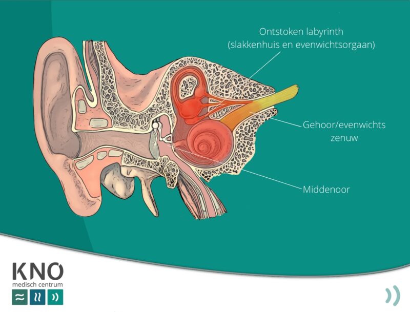 labyrinthitis (ontstoken labyrint) KNO MEDISCH CENTRUM