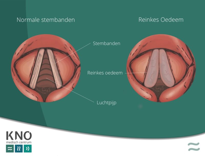 Reinkes oedeem (vocht in de stemband) KNO MEDISCH CENTRUM