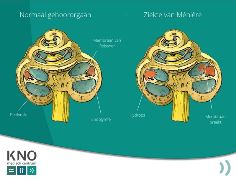 Eerste Symptomen Ziekte Van Meniere