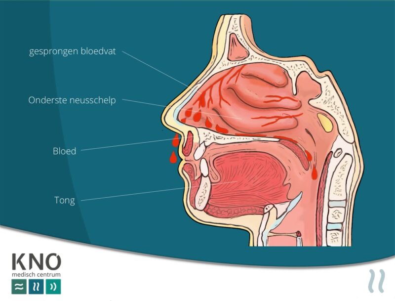 Bloedneus Epistaxis Kno Medisch Centrum