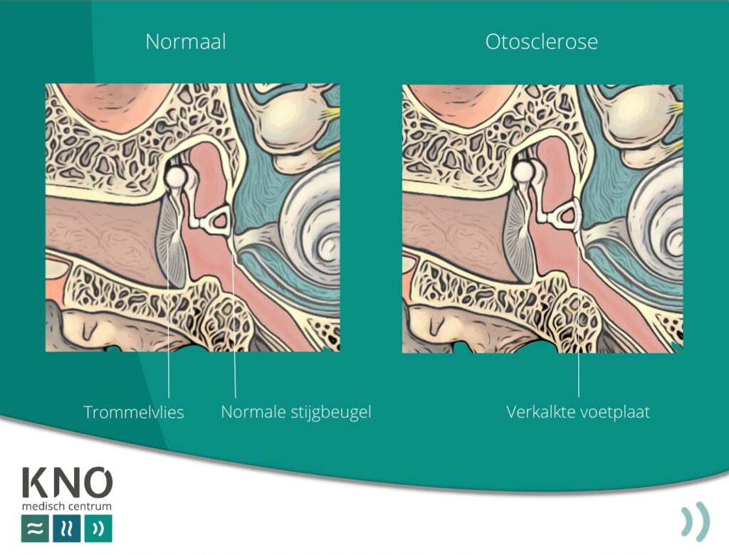 otosclerose