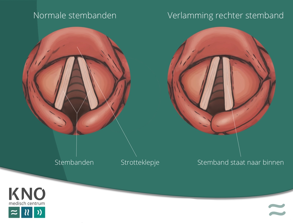 Stembandverlamming