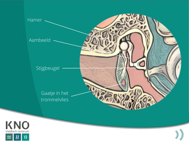trommelvlies perforatie (gaatje) - KNO MEDISCH CENTRUM