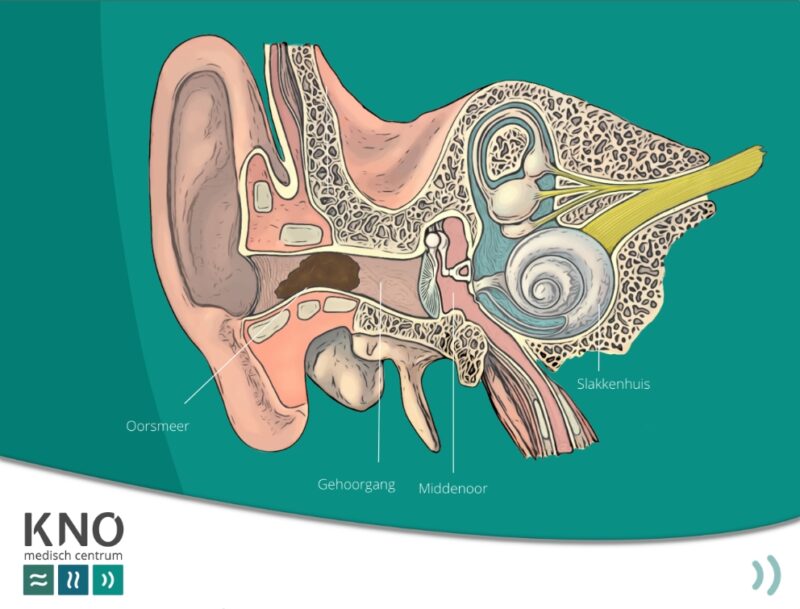 veel oorsmeer (cerumen) - KNO MEDISCH CENTRUM